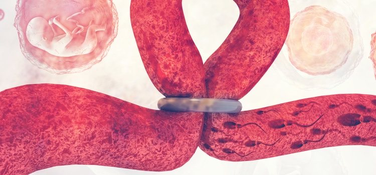 El anillo vaginal es muy útil y nada molesto