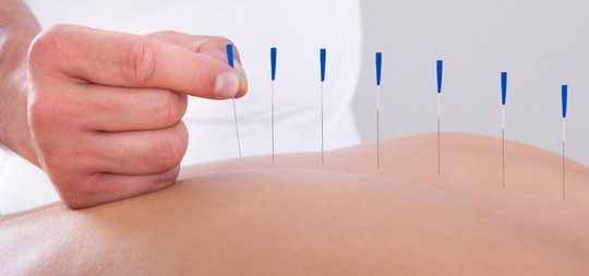 Acupuntura
